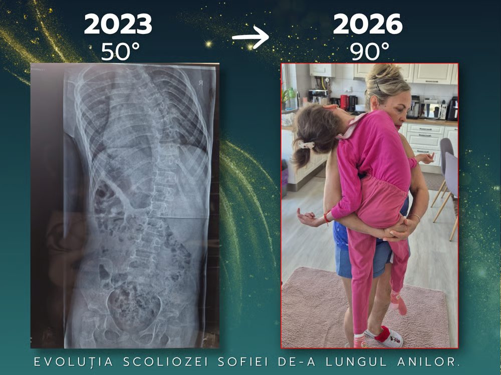 Evoluția scoliozei Sofiei: radiografie din 2023 la 50° și fotografie din 2026 la 90°